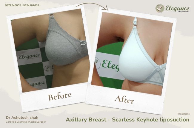 Axillary Breast - Scarless Keyhole liposuction 4 (1)
