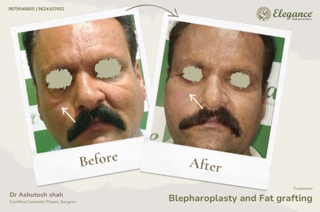 Blepharoplasty and Fat grafting 3