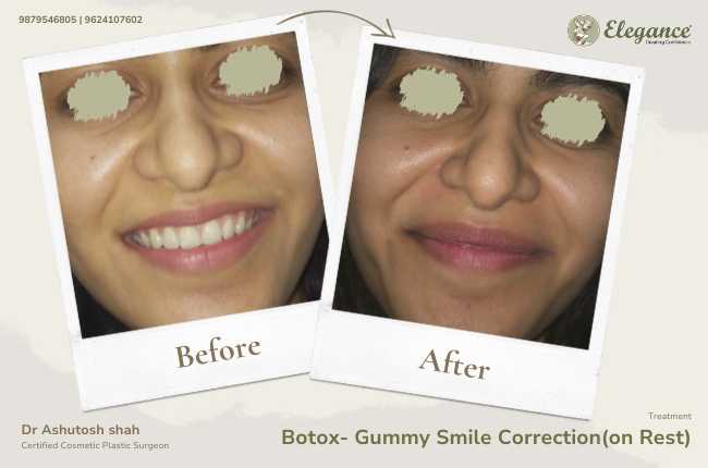Botox- Gummy Smile Correction(on Rest)