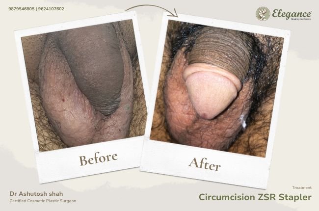 Circumcision ZSR Stapler (4)