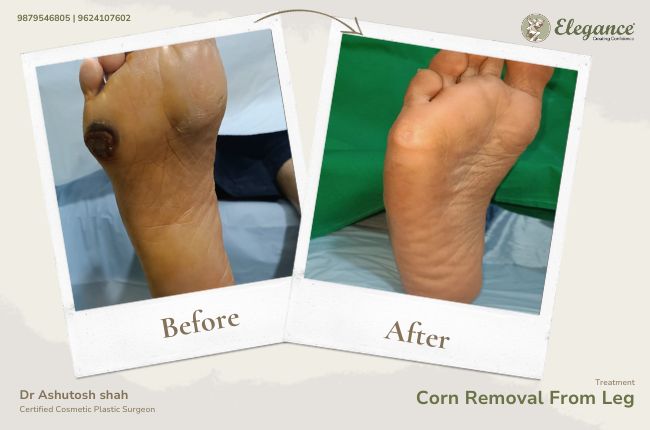Corn Removal From Leg