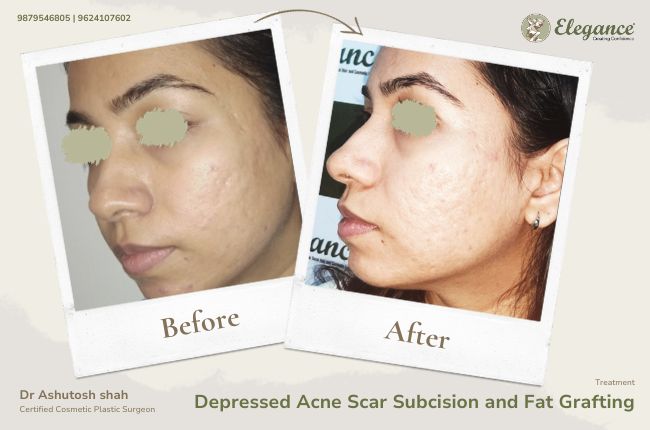 Depressed Acne Scar Subcision and Fat Grafting (2)