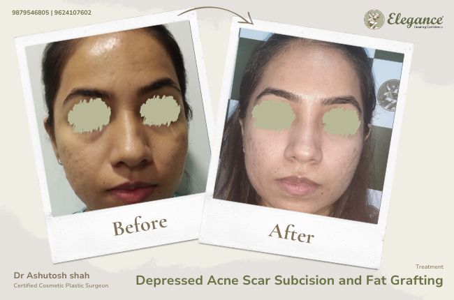 Depressed Acne Scar Subcision and Fat Grafting