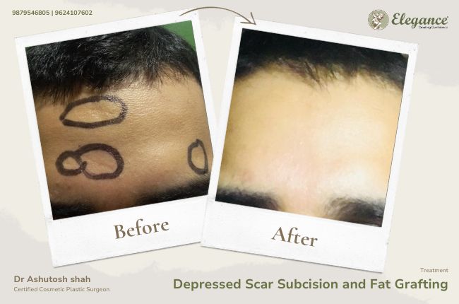 Depressed Scar Subcision and Fat Grafting (2)
