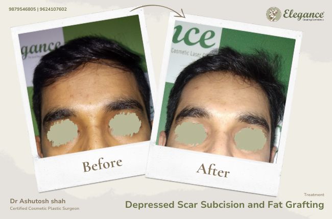 Depressed Scar Subcision and Fat Grafting
