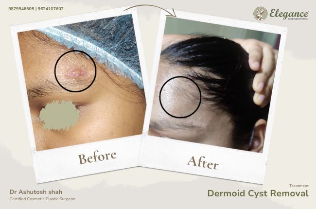Dermoid Cyst Removal