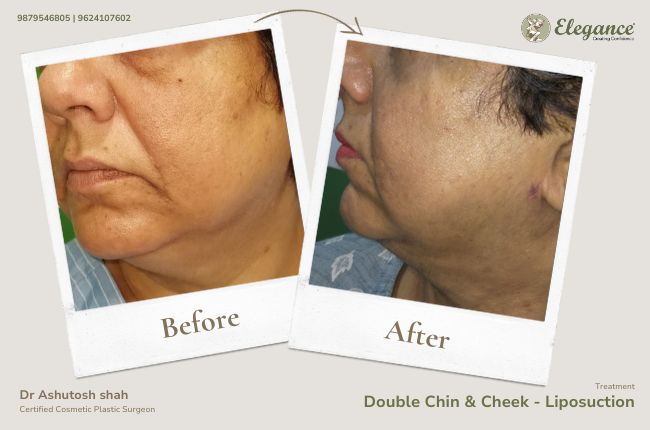 Double Chin & Cheek - Liposuction (2)