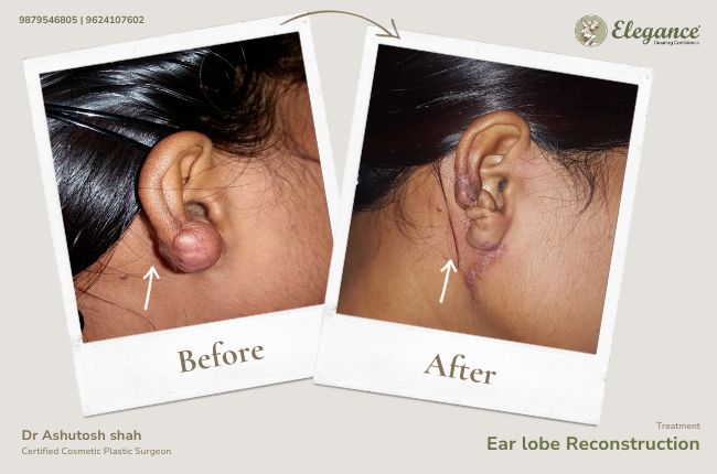 Ear lobe Reconstruction