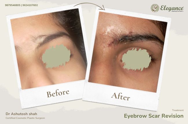 Eyebrow Scar Revision