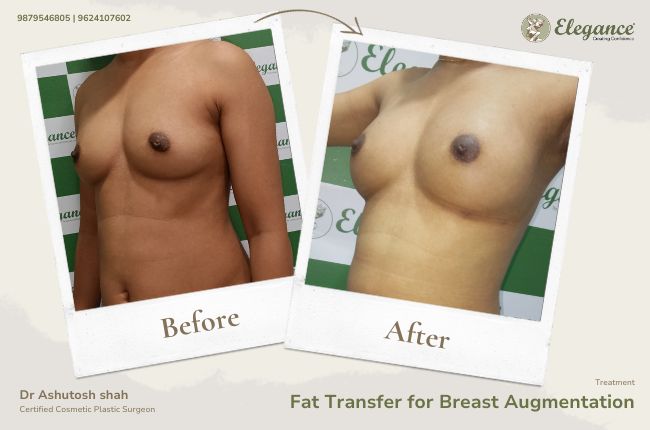 Fat Transfer for Breast Augmentation (2)