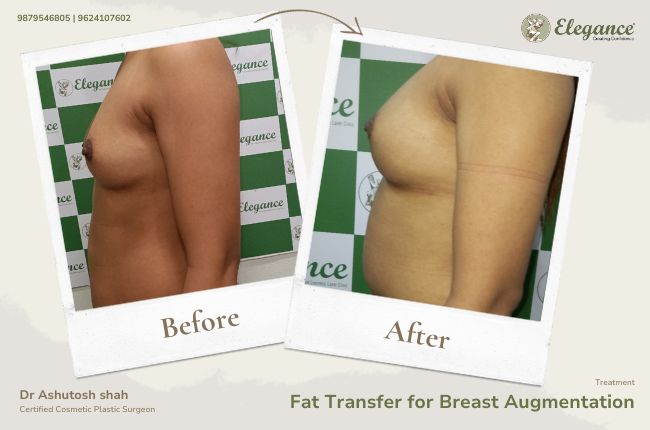 Fat Transfer for Breast Augmentation (3)