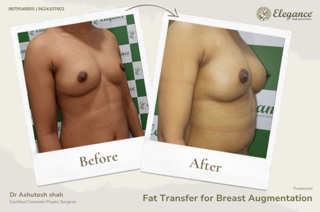 Fat Transfer for Breast Augmentation (4)