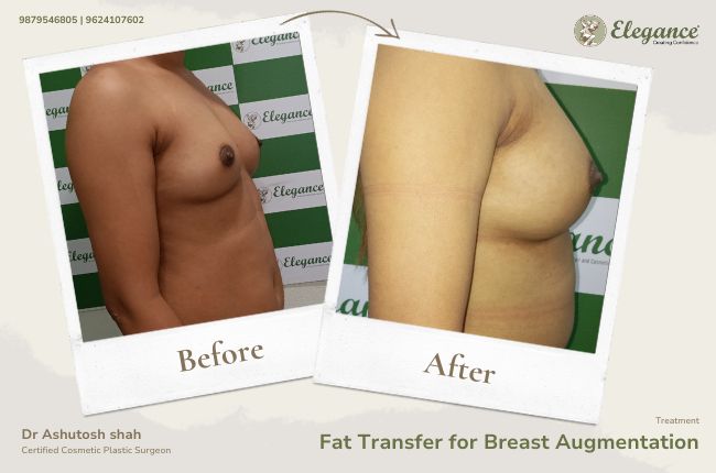 Fat Transfer for Breast Augmentation (5)