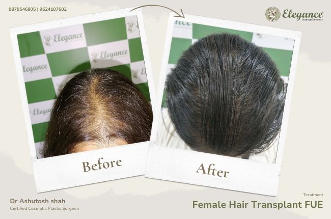 Female Hair Transplant FUE