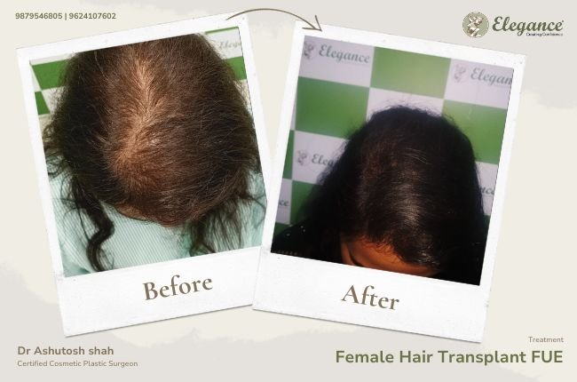 Female Hair Transplant FUT (5)