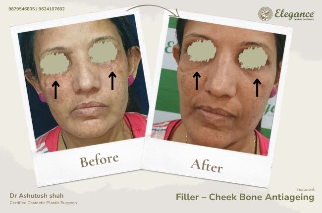 Filler – Cheek Bone Antiageing(1)