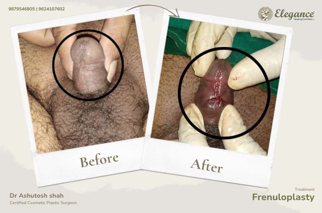 Frenuloplasty (3)