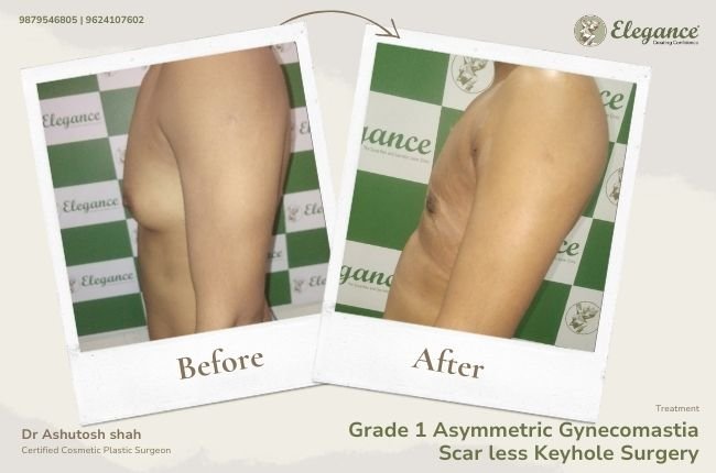 Grade 1 Asymmetric Gynecomastia Scar less Keyhole Surgery (2)