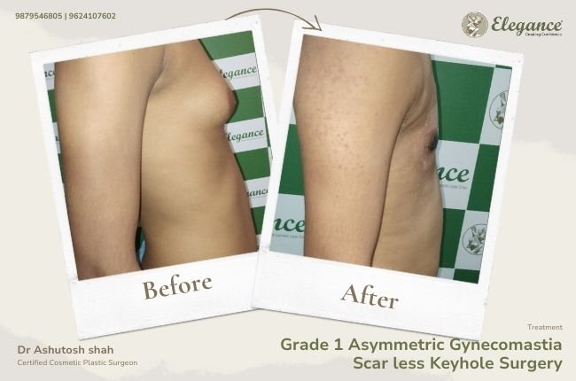 Grade 1 Asymmetric Gynecomastia Scar less Keyhole Surgery