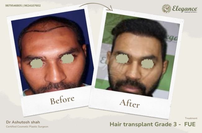 Hair transplant Grade 3 - FUE (2)