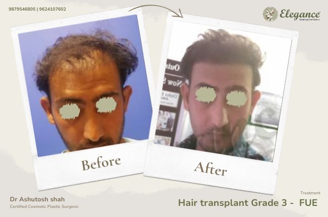 Hair transplant Grade 3 - FUE