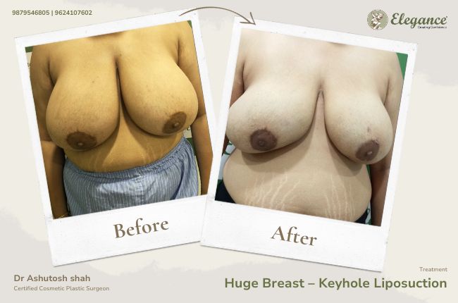 Huge Breast – Keyhole Liposuction