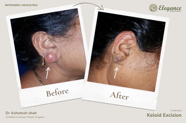 Keloid Excision (2)
