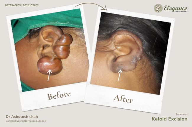 Keloid Excision (3)