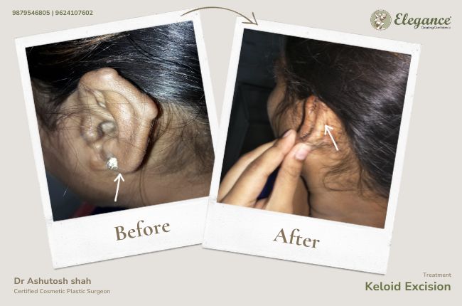 Keloid Excision (4)