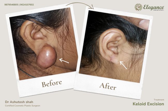 Keloid Excision (6)