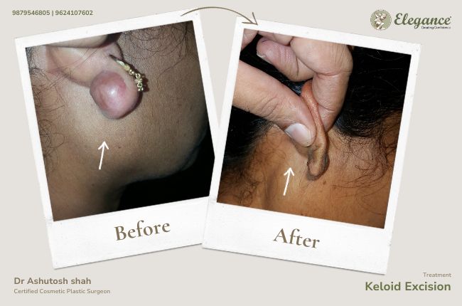 Keloid Excision