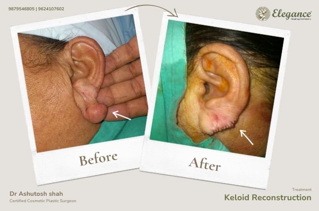 Keloid Reconstruction (2)(1)