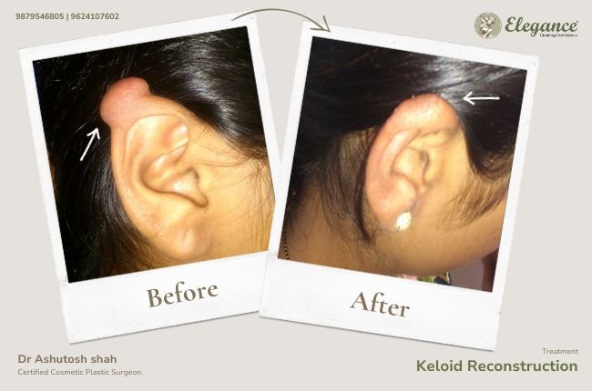 Keloid Reconstruction (3)(1)