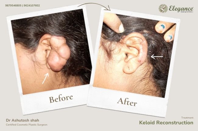 Keloid Reconstruction (4)