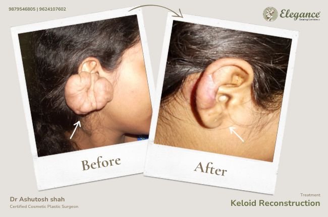 Keloid Reconstruction (5)