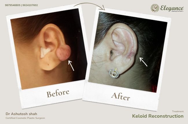 Keloid Reconstruction(1)