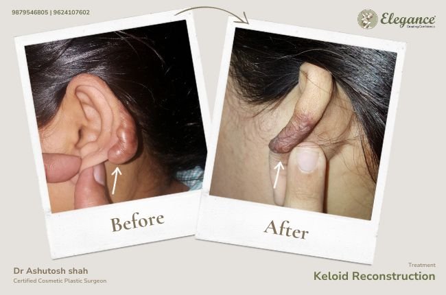 Keloid reconstruction (2)