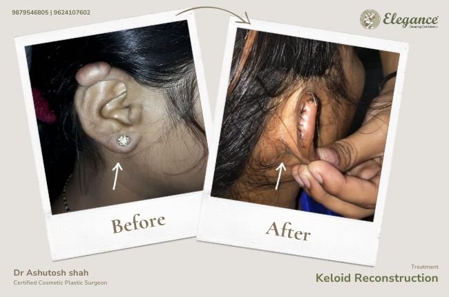 Keloid reconstruction (3)