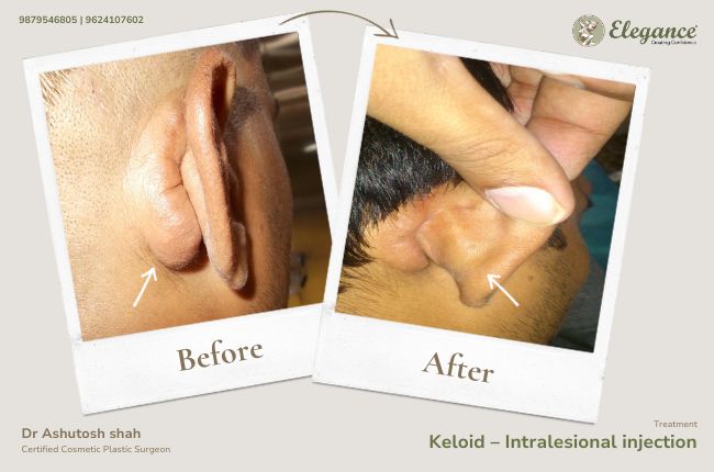Keloid – Intralesional excision