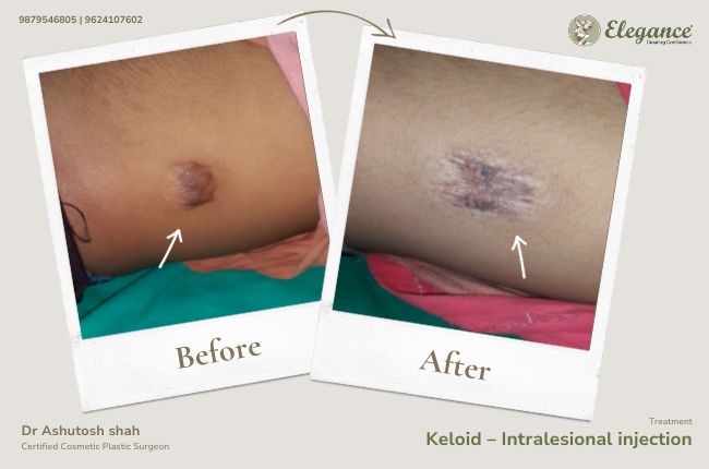 Keloid – Intralesional injection