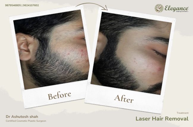 Laser Hair Removal (10)