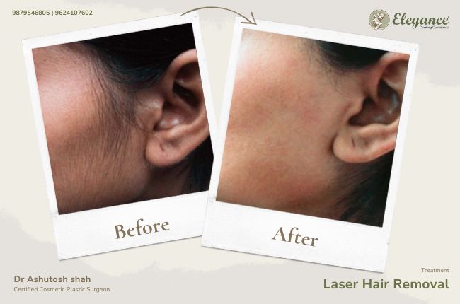 Laser Hair Removal (11)