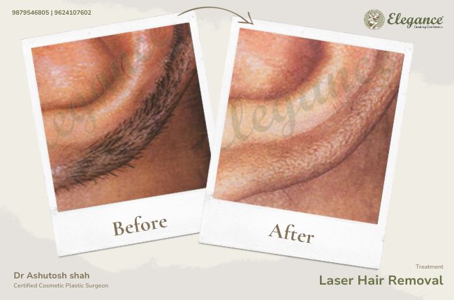 Laser Hair Removal (12)