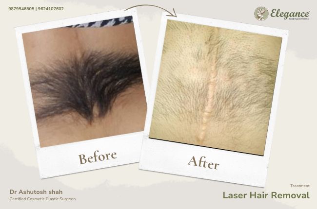 Laser Hair Removal (13)