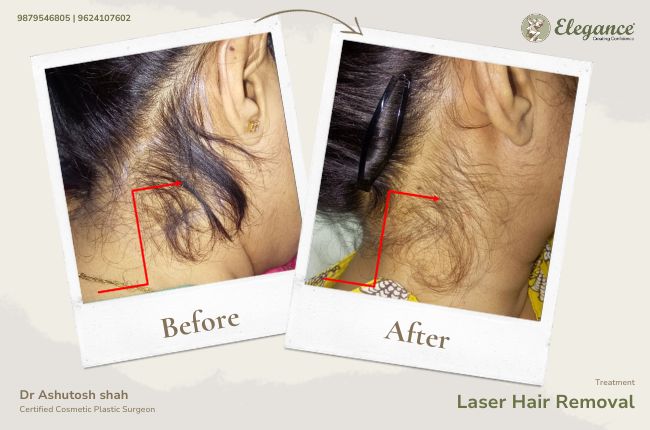 Laser Hair Removal (4)