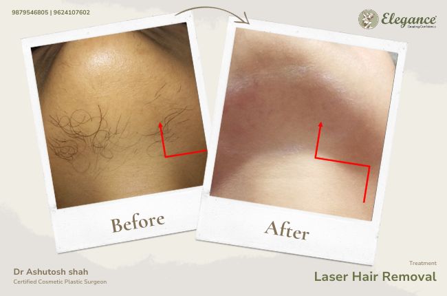 Laser Hair Removal (5)