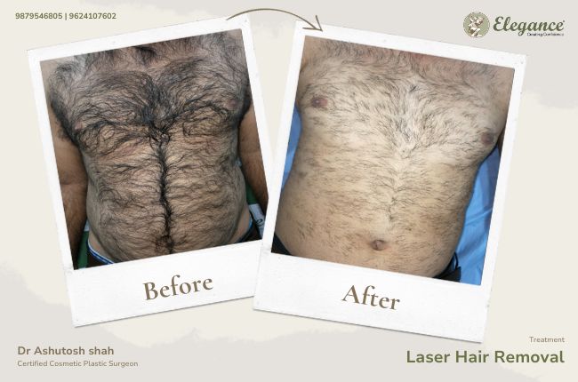 Laser Hair Removal (6)