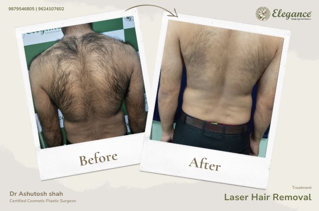 Laser Hair Removal (7)
