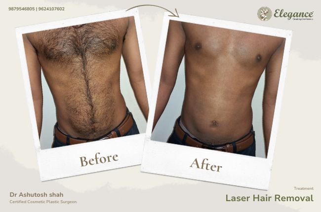 Laser Hair Removal (8)