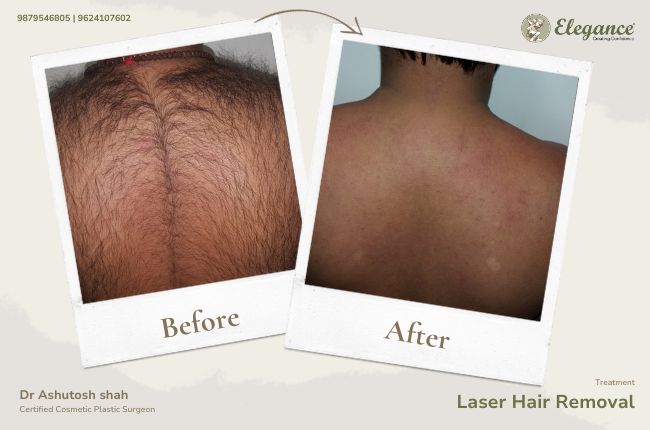 Laser Hair Removal (9)